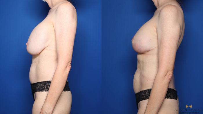 Before & After Breast Implant Exchange (Breast Revision) Case 509 Left Side View in Fort Worth & Arlington, Texas