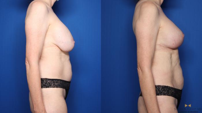 Before & After Breast Implant Exchange (Breast Revision) Case 509 Right Side View in Fort Worth & Arlington, Texas