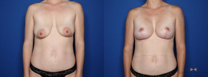 Before & After Breast Implant Exchange (Breast Revision) Case 541 Front View in Fort Worth & Arlington, Texas