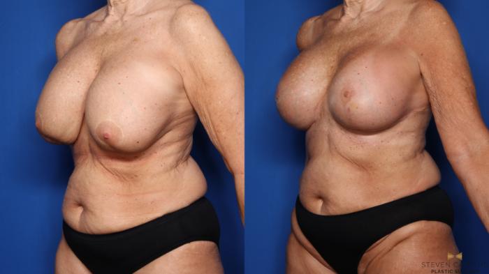 Before & After Breast Implant Exchange (Breast Revision) Case 553 Left Oblique View in Fort Worth & Arlington, Texas