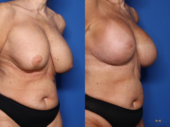 Before & After Breast Implant Exchange (Breast Revision) Case 553 Right Oblique View in Fort Worth & Arlington, Texas