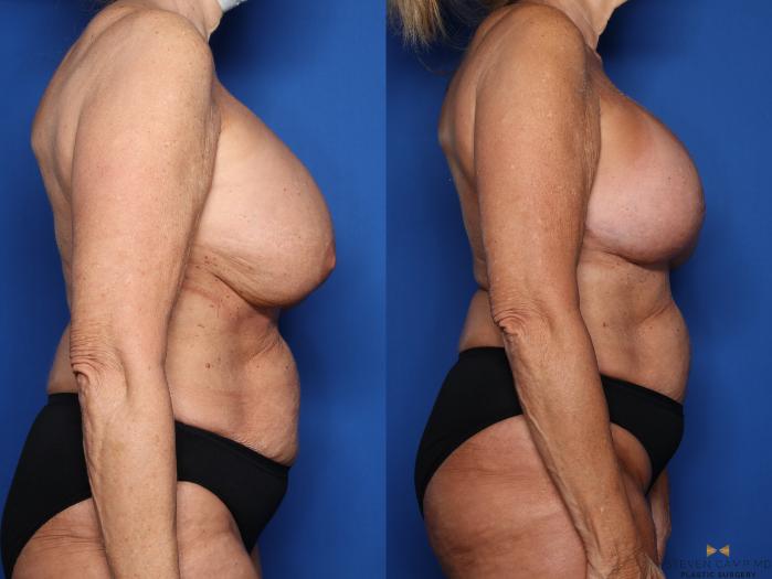 Before & After Breast Implant Exchange (Breast Revision) Case 553 Right Side View in Fort Worth & Arlington, Texas