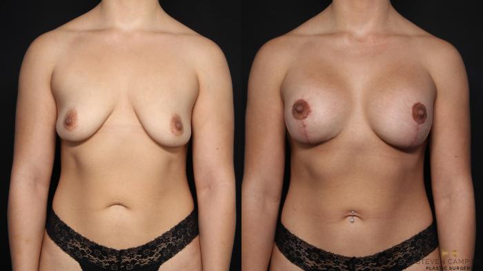 Before & After Breast Implant Exchange, Mastopexy & Internal Bra Case 644 Front View in Fort Worth, Texas