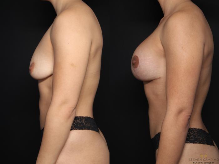 Before & After Breast Implant Exchange (Breast Revision) Case 644 Left Side View in Fort Worth & Arlington, Texas