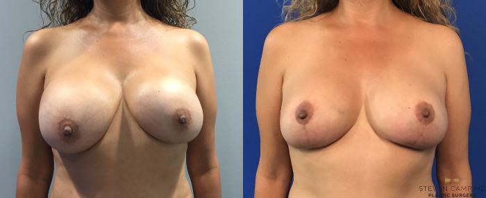 Before & After Breast Lift with or without Implants Case 98 View #1 View in Fort Worth, Texas
