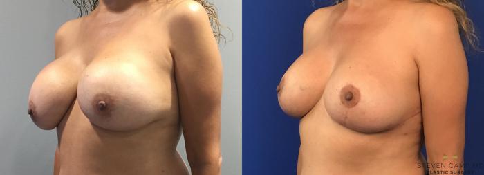 Before & After Breast Lift (Breast Mastopexy with Implants) Case 98 View #2 View in Fort Worth & Arlington, Texas