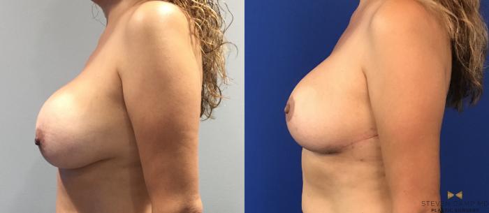 Before & After Breast Implant Exchange (Breast Revision) Case 98 View #3 View in Fort Worth & Arlington, Texas