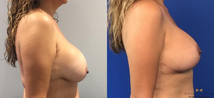 Before & After Breast Lift (Breast Mastopexy with Implants) Case 98 View #5 View in Fort Worth & Arlington, Texas