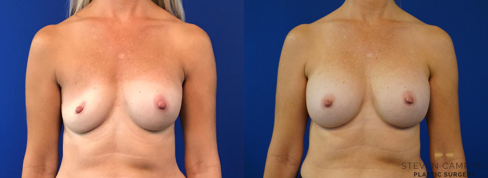 Before & After Breast Implant Exchange - NO LIFT  Case 125 View #1 View in Fort Worth & Arlington, Texas