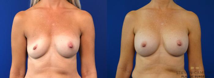 Before & After Breast Implant Exchange - NO LIFT  Case 125 View #1 View in Fort Worth & Arlington, Texas