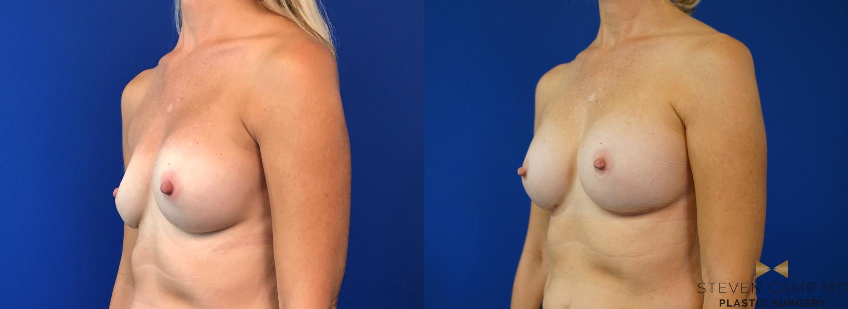 Before & After Breast Implant Exchange - NO LIFT  Case 125 View #2 View in Fort Worth & Arlington, Texas