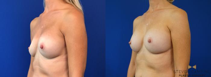 Before & After Breast Implant Exchange - NO LIFT  Case 125 View #2 View in Fort Worth & Arlington, Texas