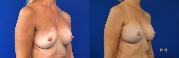 Before & After Breast Implant Exchange - NO LIFT  Case 125 View #4 View in Fort Worth & Arlington, Texas