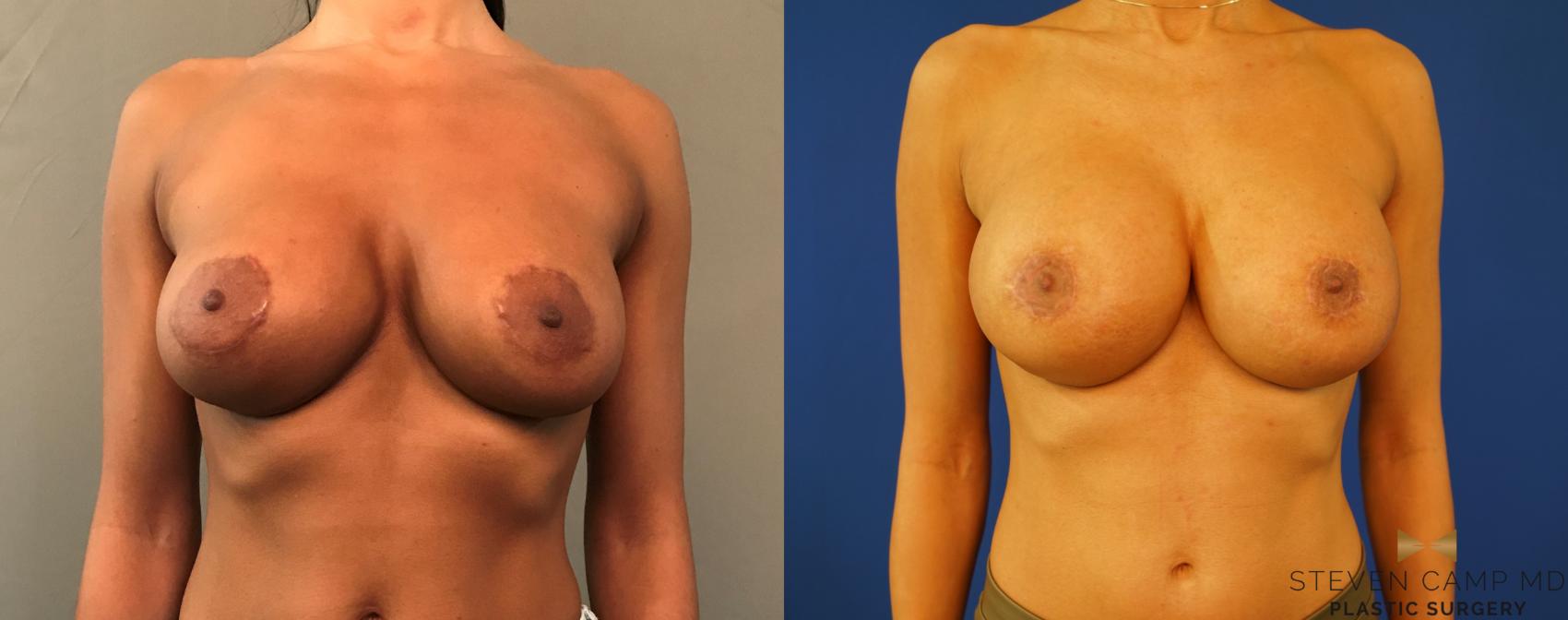 Before & After Breast Implant Exchange - NO LIFT  Case 142 View #1 View in Fort Worth & Arlington, Texas