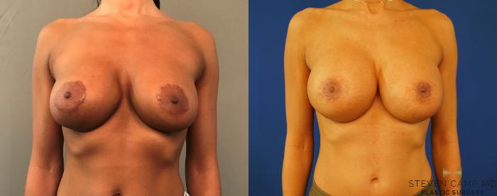 Before & After Breast Implant Exchange - NO LIFT  Case 142 View #1 View in Fort Worth & Arlington, Texas