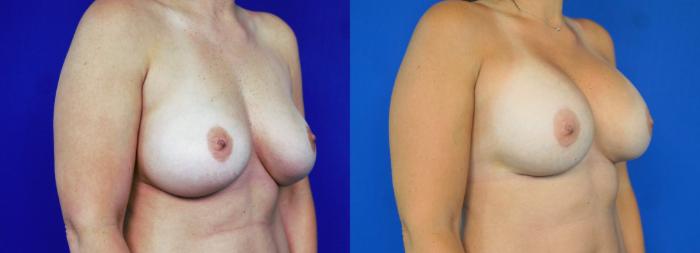 Before & After Breast Implant Exchange - NO LIFT  Case 201 View #3 View in Fort Worth & Arlington, Texas