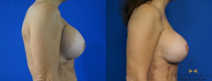 Before & After Breast Implant Exchange - NO LIFT  Case 288 View #3 View in Fort Worth & Arlington, Texas