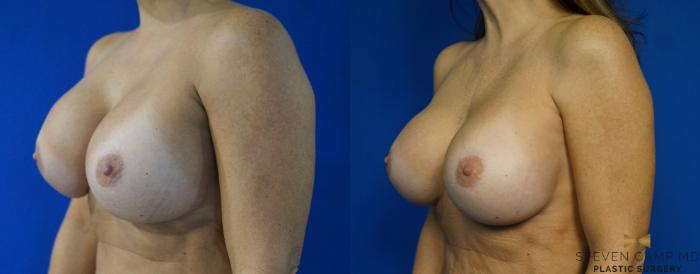 Before & After Breast Implant Exchange - NO LIFT  Case 288 View #4 View in Fort Worth & Arlington, Texas