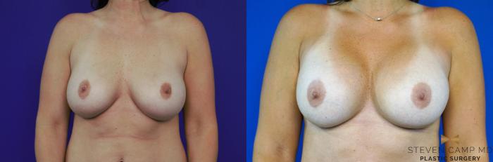 Before & After Breast Implant Exchange - NO LIFT  Case 290 View #1 View in Fort Worth & Arlington, Texas