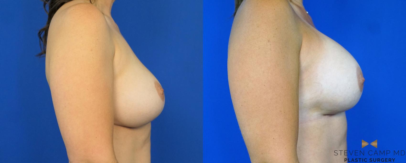Before & After Breast Implant Exchange - NO LIFT  Case 290 View #3 View in Fort Worth & Arlington, Texas