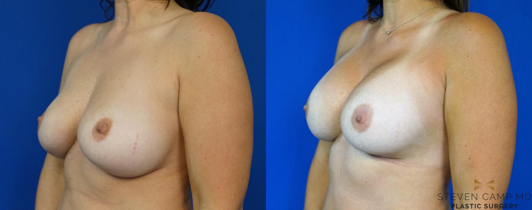 Before & After Breast Implant Exchange - NO LIFT  Case 290 View #4 View in Fort Worth & Arlington, Texas