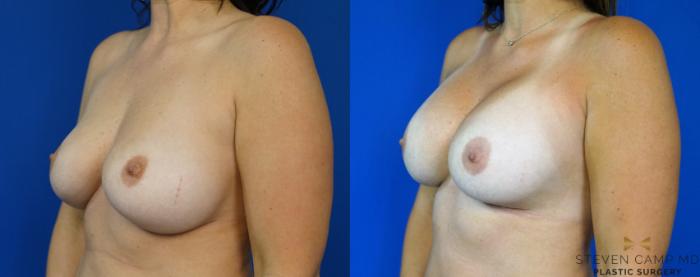 Before & After Breast Implant Exchange - NO LIFT  Case 290 View #4 View in Fort Worth & Arlington, Texas