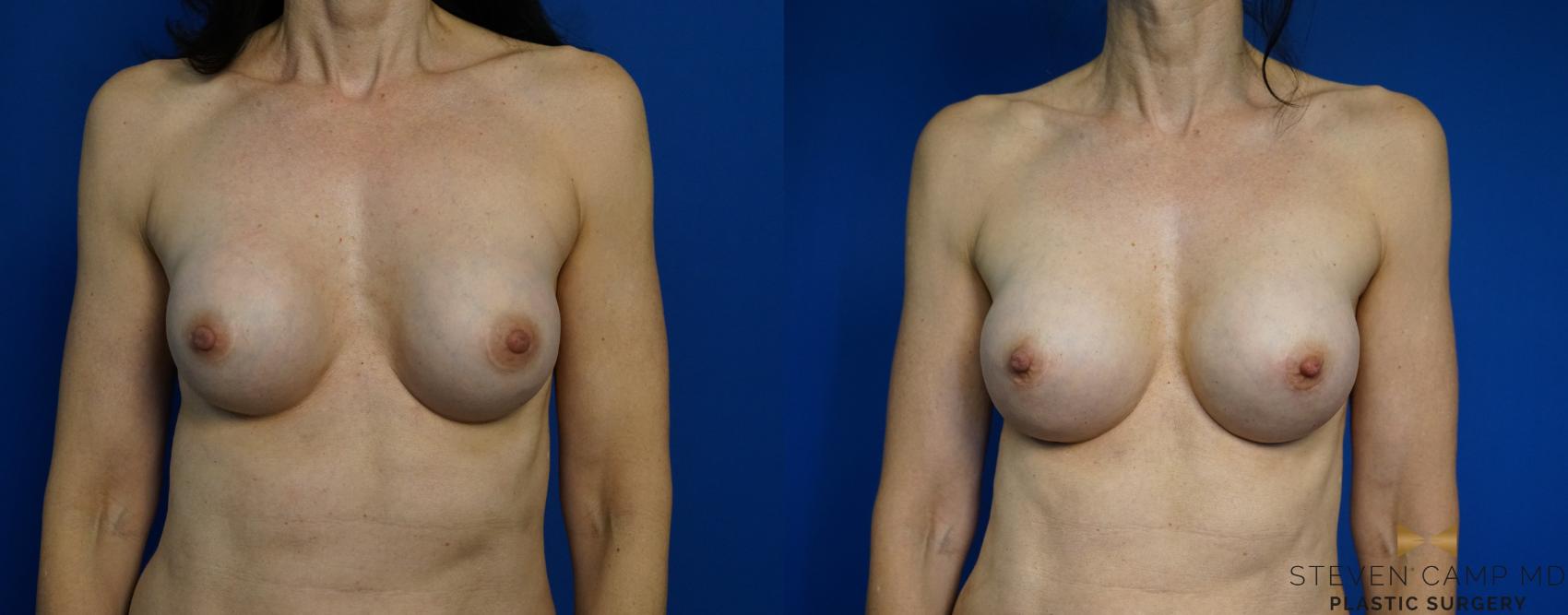 Before & After Breast Implant Exchange - NO LIFT  Case 297 View #1 View in Fort Worth & Arlington, Texas