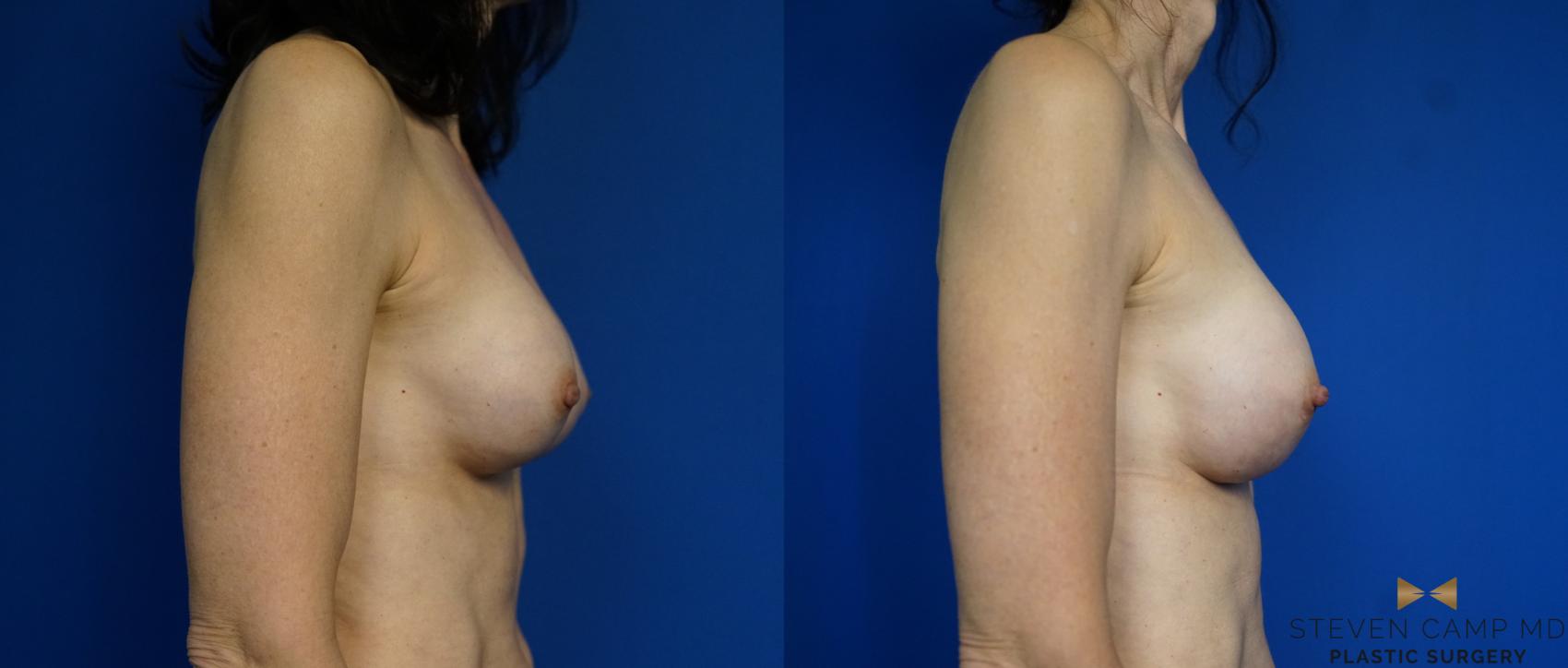 Before & After Breast Implant Exchange - NO LIFT  Case 297 View #3 View in Fort Worth & Arlington, Texas