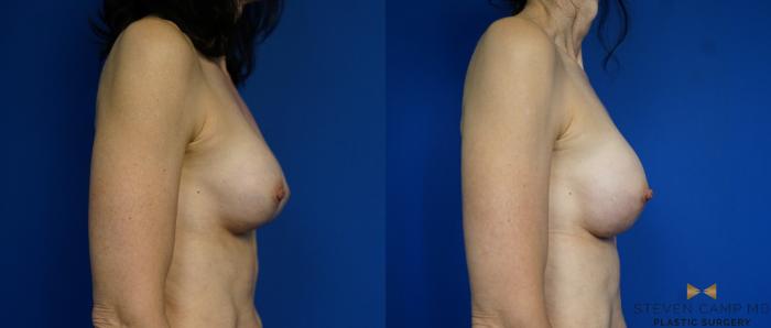 Before & After Breast Implant Exchange - NO LIFT  Case 297 View #3 View in Fort Worth & Arlington, Texas