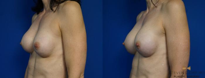 Before & After Breast Implant Exchange - NO LIFT  Case 297 View #4 View in Fort Worth & Arlington, Texas