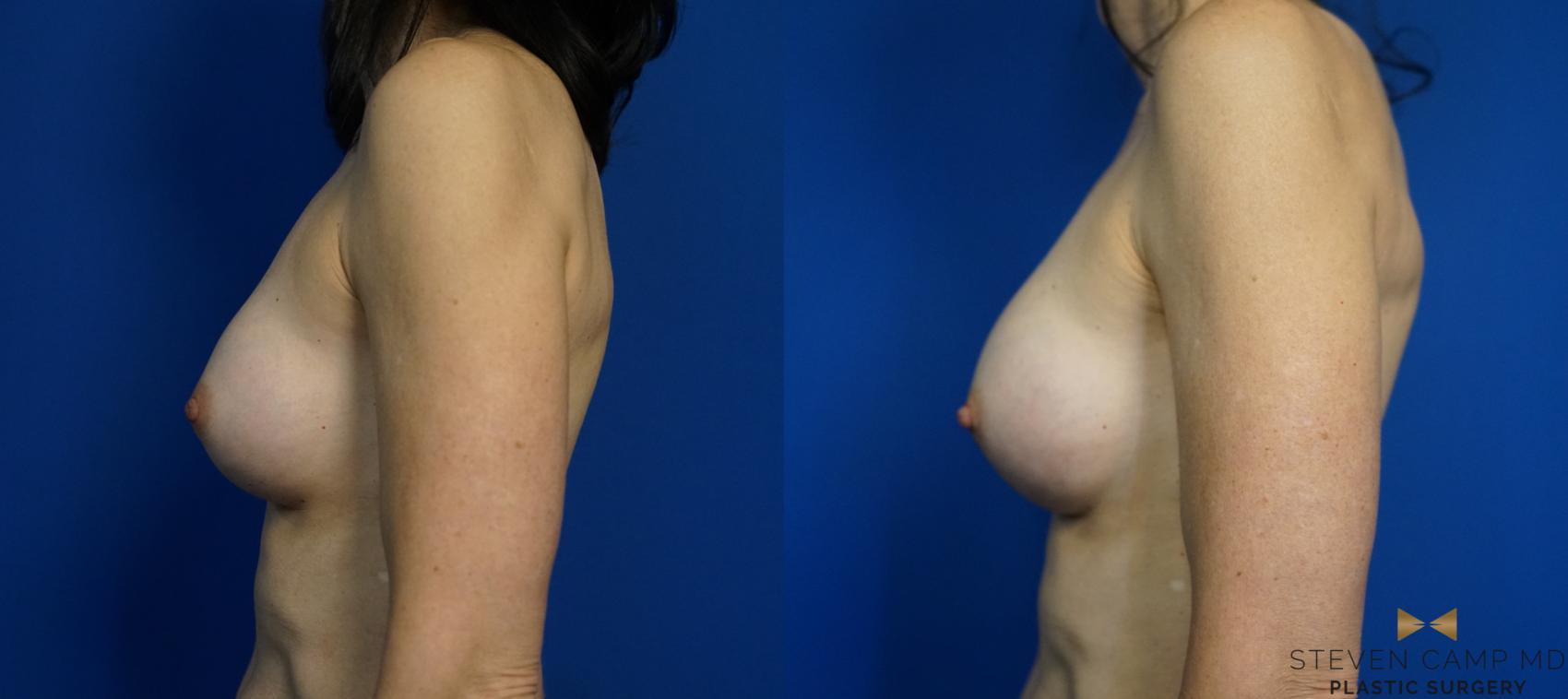 Before & After Breast Implant Exchange - NO LIFT  Case 297 View #5 View in Fort Worth & Arlington, Texas