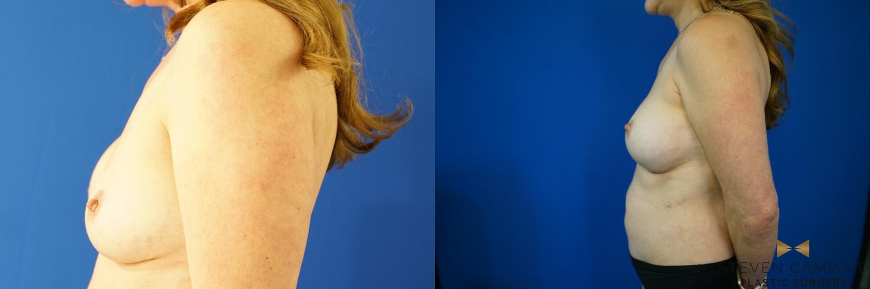 Before & After Breast Implant Exchange - NO LIFT  Case 354 Left Side View in Fort Worth & Arlington, Texas