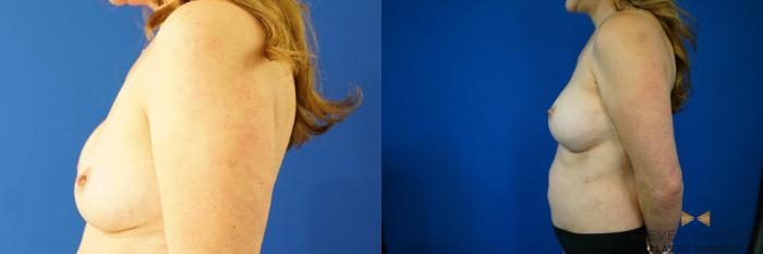 Before & After Breast Implant Exchange - NO LIFT  Case 354 Left Side View in Fort Worth & Arlington, Texas