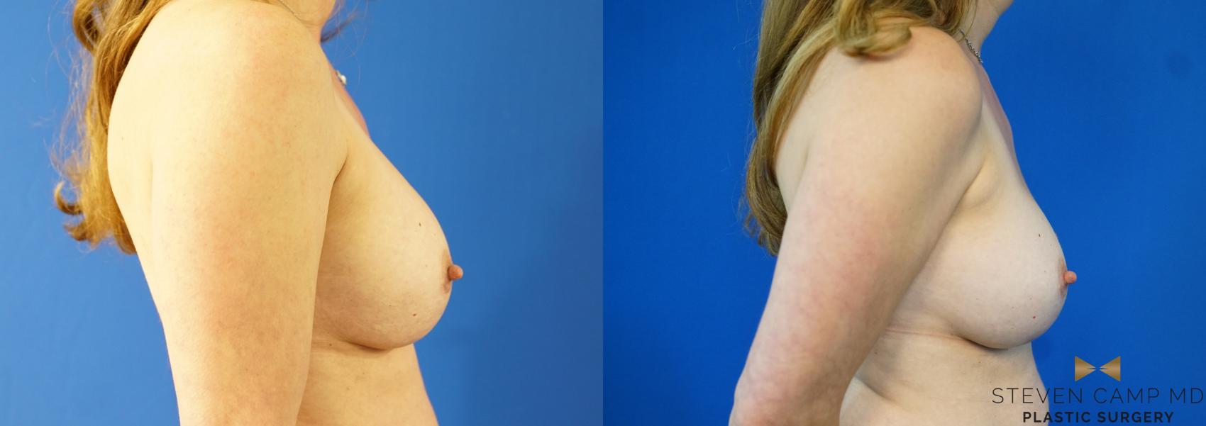Before & After Breast Implant Exchange - NO LIFT  Case 354 Right Side View in Fort Worth & Arlington, Texas