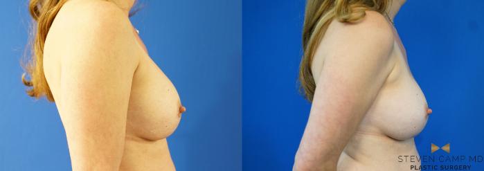 Before & After Breast Implant Exchange - NO LIFT  Case 354 Right Side View in Fort Worth & Arlington, Texas