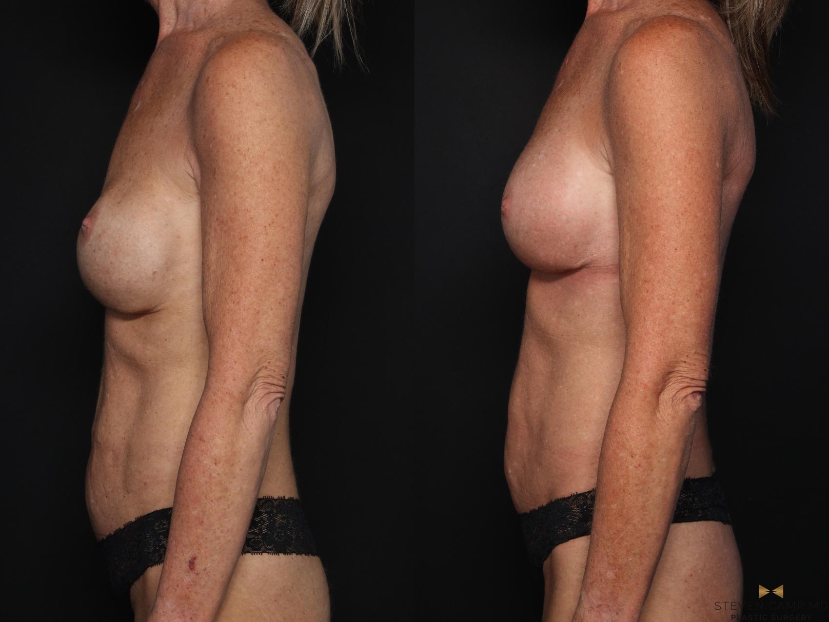Before & After Breast Implant Exchange - NO LIFT  Case 709 Left Side View in Fort Worth & Arlington, Texas