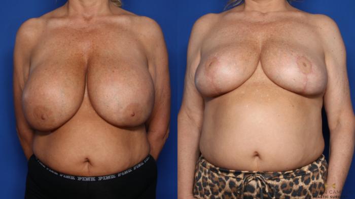 Before & After Breast Implant Explantation Case 459 Front View in Fort Worth & Arlington, Texas