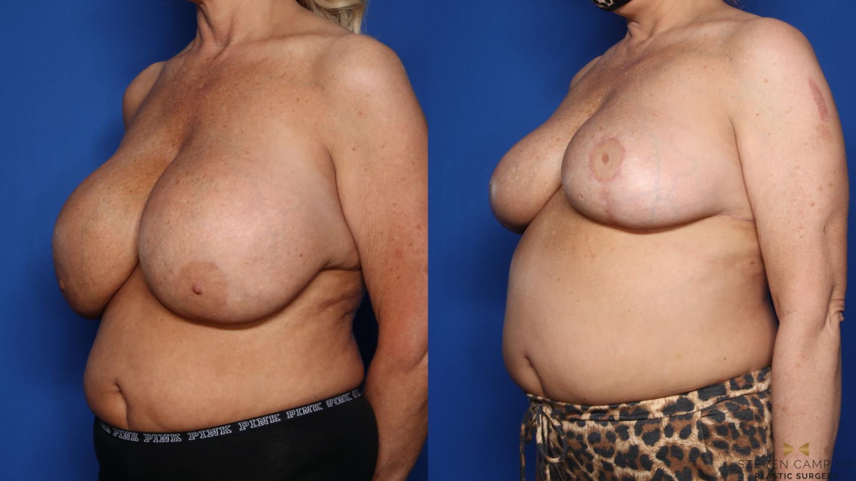 Before & After Breast Implant Explantation Case 459 Left Oblique View in Fort Worth & Arlington, Texas