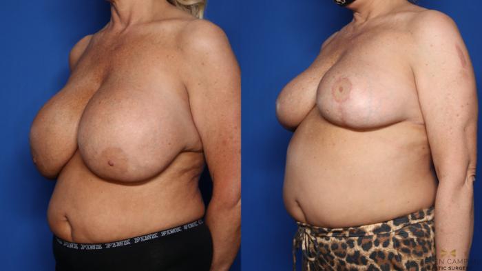 Before & After Breast Implant Explantation Case 459 Left Oblique View in Fort Worth & Arlington, Texas