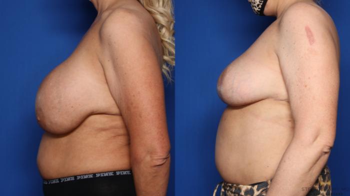 Before & After Breast Implant Explantation Case 459 Left Side View in Fort Worth & Arlington, Texas