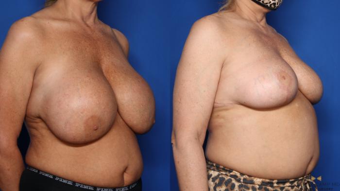 Before & After Breast Implant Explantation Case 459 Right Oblique View in Fort Worth & Arlington, Texas