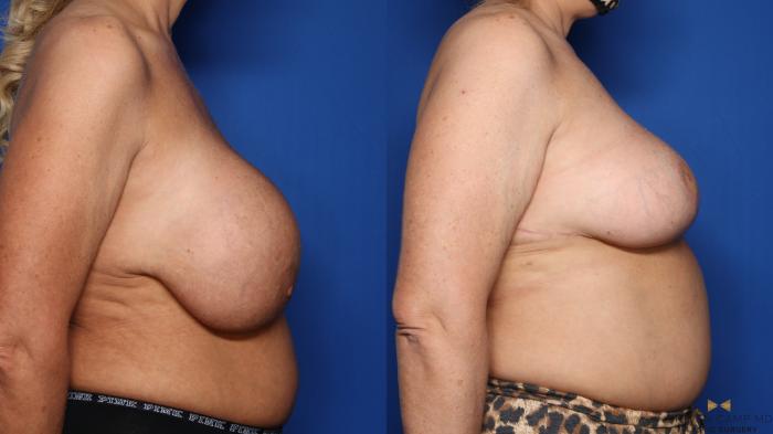 Before & After Breast Implant Explantation Case 459 Right Side View in Fort Worth & Arlington, Texas