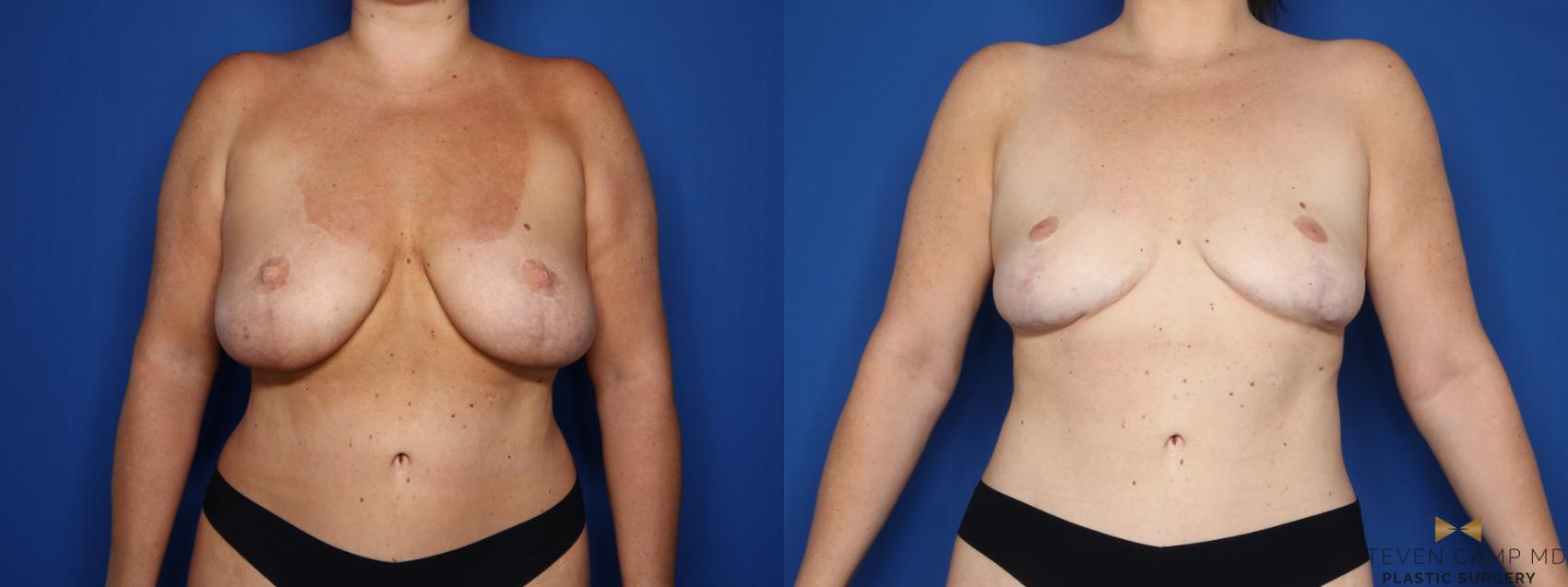 Before & After Breast Implant Explantation Case 654 Front View in Fort Worth & Arlington, Texas