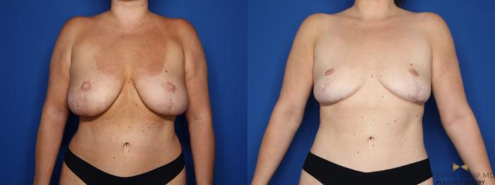 Before & After Breast Implant Explantation Case 654 Front View in Fort Worth & Arlington, Texas