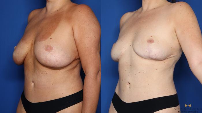 Before & After Breast Implant Explantation Case 654 Left Oblique View in Fort Worth & Arlington, Texas