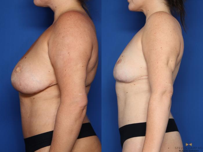 Before & After Breast Implant Explantation Case 654 Left Side View in Fort Worth & Arlington, Texas