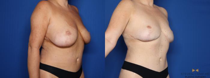 Before & After Breast Implant Explantation Case 654 Right Oblique View in Fort Worth & Arlington, Texas