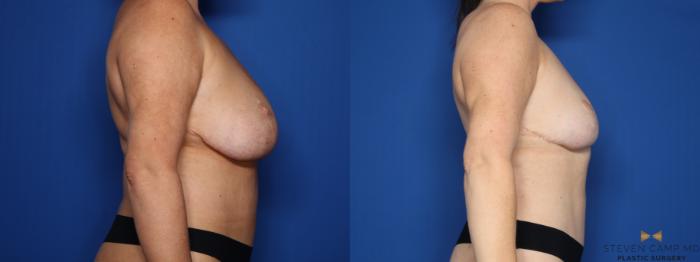 Before & After Breast Implant Explantation Case 654 Right Side View in Fort Worth & Arlington, Texas