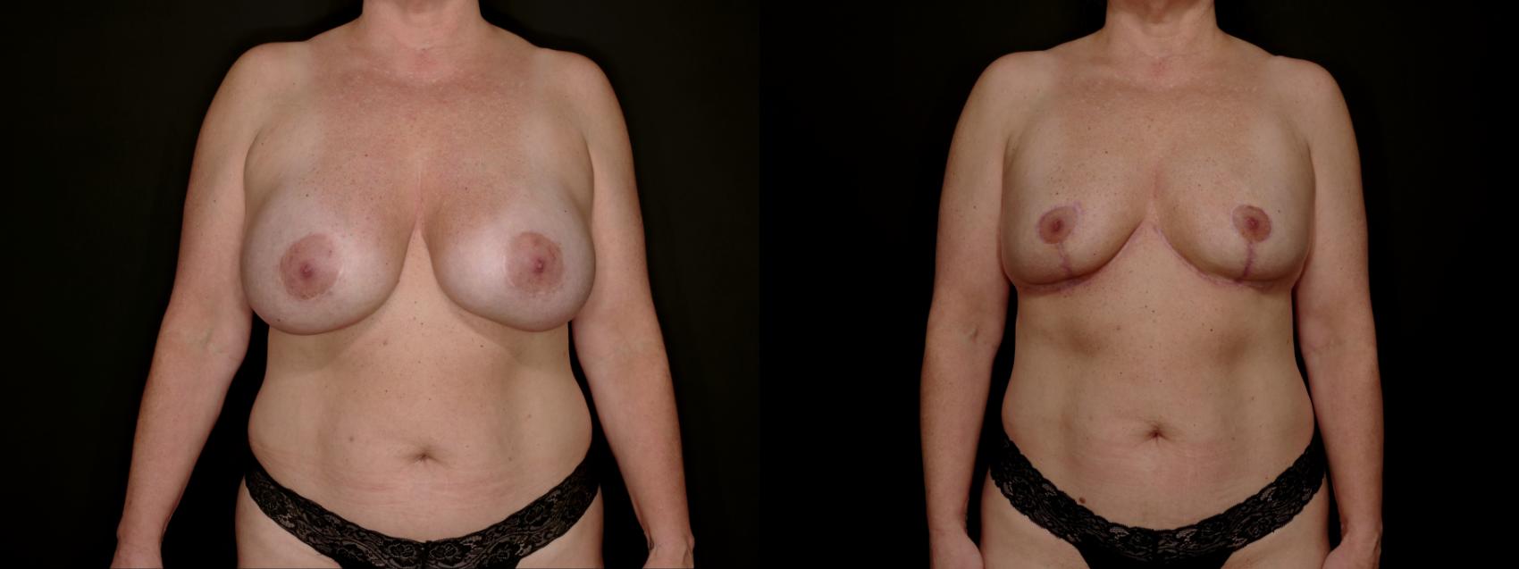 Before & After Breast Lift (Breast Mastopexy - No Implants) Case 761 Front View in Fort Worth & Arlington, Texas