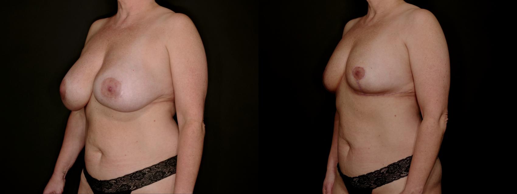 Before & After Breast Lift (Breast Mastopexy - No Implants) Case 761 Left Oblique View in Fort Worth & Arlington, Texas